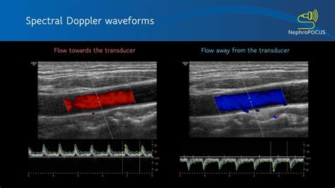 Basics of Doppler Ultrasound for the Nephrologist- Part 2 - Renal ...