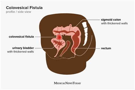 Causes Of Abdominal Fistulas