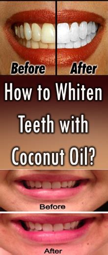 How to Whiten Teeth with Coconut Oil? - barbarasharetips.blogspot.com