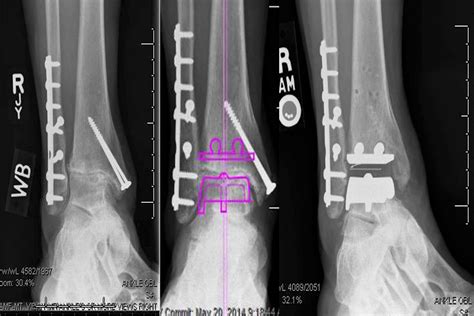 The Ankle Surgeon - What You Need to Know About Ankle Replacement