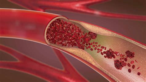 What Causes Plaque in the Arteries?