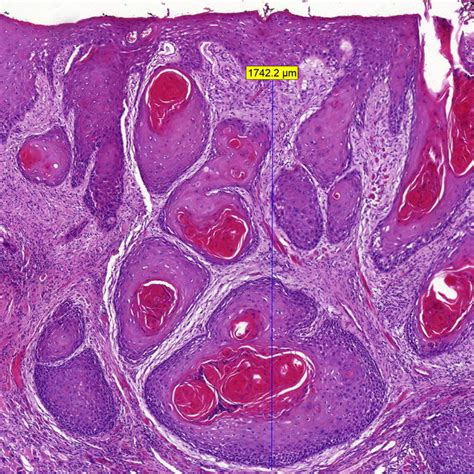 Histopathological slide of an oral squamous cell carcinoma showing ...