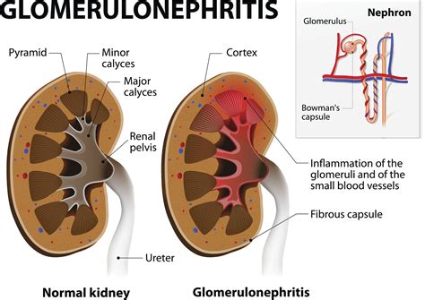 Causes of Kidney Disease