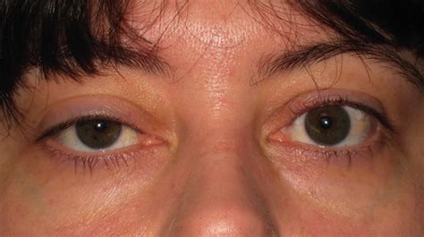 Ptosis: Causes, Classification, Symptoms, Pathology and Treatment - Scope Heal