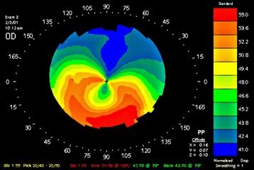 Corneal Topography Eye Tests at best price in Nagpur | ID: 19345261330