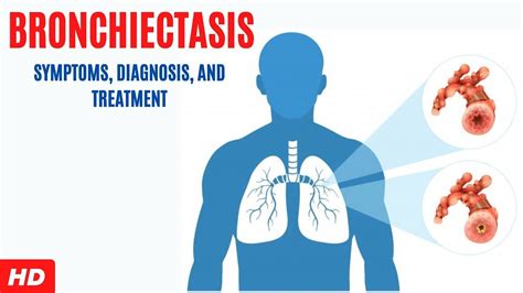 Bronchiectasis: Symptoms, Diagnosis and Treatment - YouTube