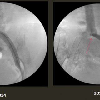 Secondary interventions after iliac vein stenting for chronic proximal venous outflow ...