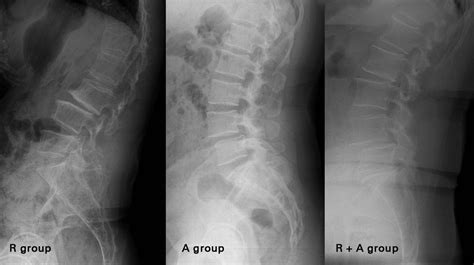 Degenerative retrolisthesis | Bone & Joint