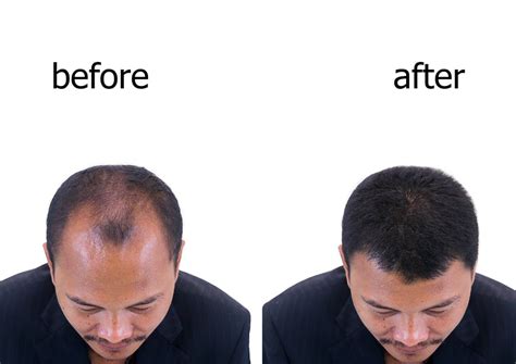 Home - RegenRx Hair Restoration