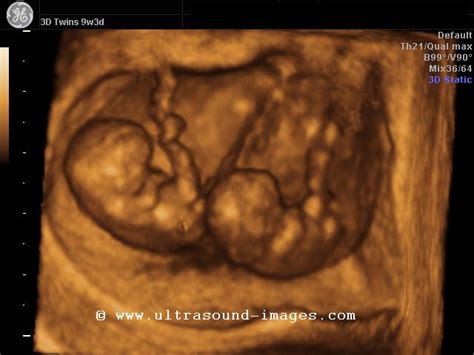 Twin 3d Ultrasound