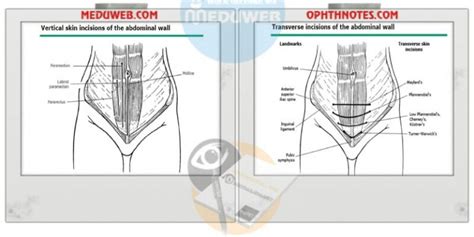 Abdominal Hysterectomy Technique - Meduweb