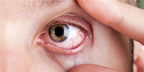 Dry Eye Syndrome Symptoms | Brooks Eye Associates