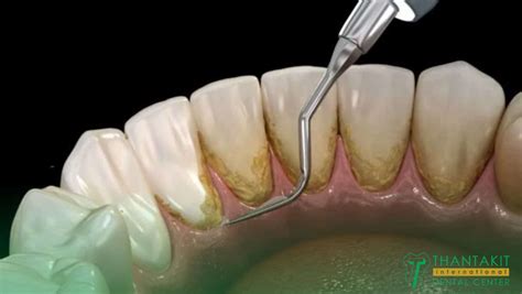 The Causes, Prevention, and Treatment of Receding Gums