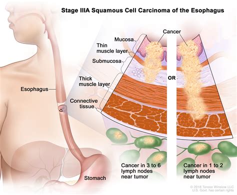 Etapas del cáncer de esófago - Medicina Básica