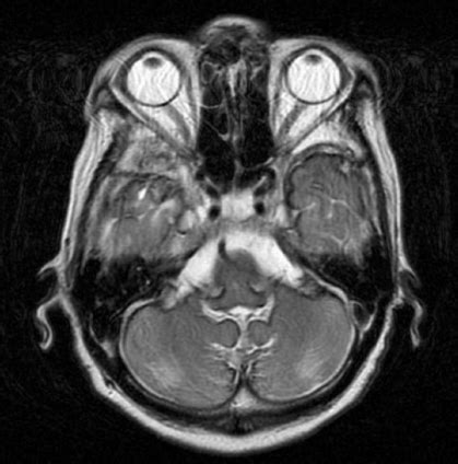 MRI of the brain showing superficial siderosis after VP shunt... | Download Scientific Diagram