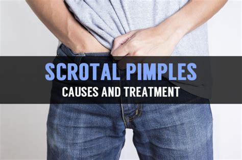 Causes and Treatment for Pimple on Scrotum or Testicles