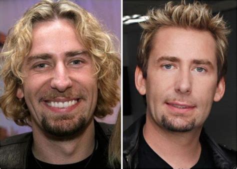 Chad Kroeger nose job. | Chad kroeger, Plastic surgery, Chad