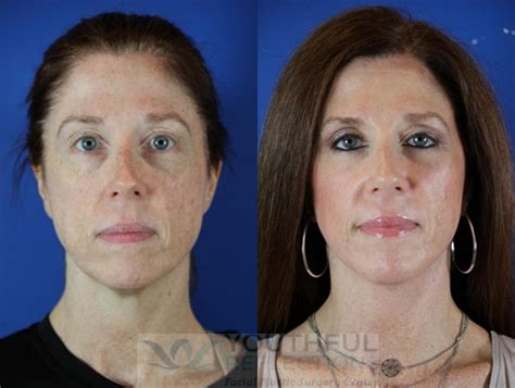 Laser Skin Resurfacing Before And After - 02/2022