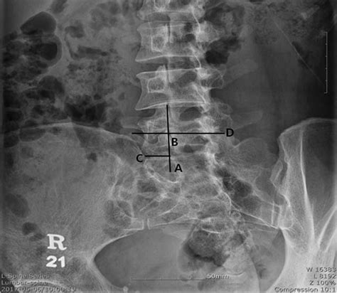 Lumbar Spine Posterior View