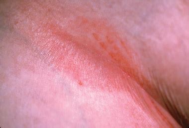 How do you explain this chronic, malodorous rash? | Consultant360