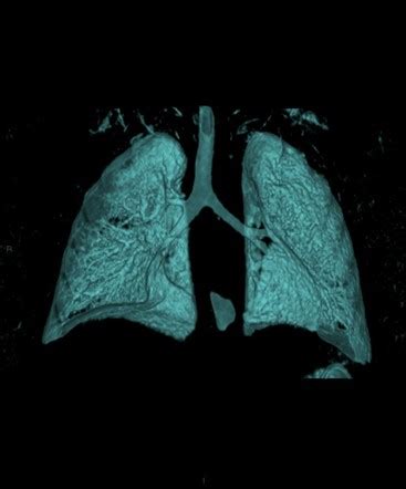 CT bronchography | Radiology Case | Radiopaedia.org