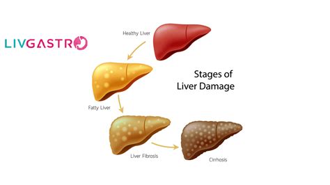 Fatty Liver Disease: Forms, Symptoms, Diagnosis & Treatment LivGastro