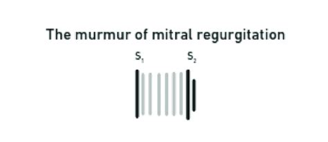 The murmur of mitral regurgitation. | Download Scientific Diagram