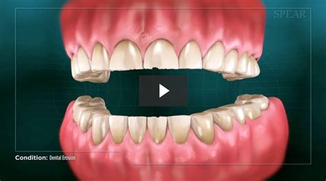 Dental Erosion - Cosmetic Dentistry