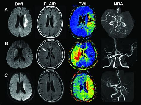 Reperfusion Therapy in Unclear-Onset Stroke Based on MRI Evaluation (RESTORE) | Stroke