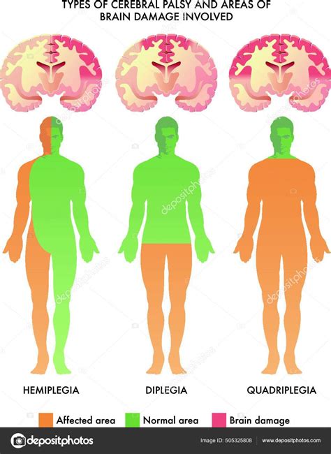 Hemiplegia | 🍓Hemiplegia / Hemiplegic Cerebral Palsy