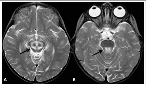 Figure 1 from The "double panda" sign in Leigh disease. - Semantic Scholar