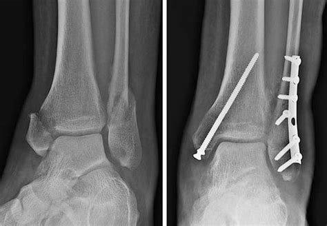 What is ankle fracture surgery? - Orthopedic Specialists of Seattle