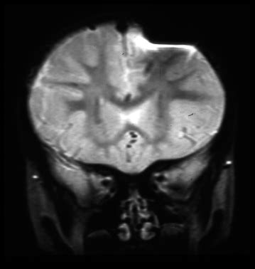 Susceptibility artifact - Questions and Answers in MRI