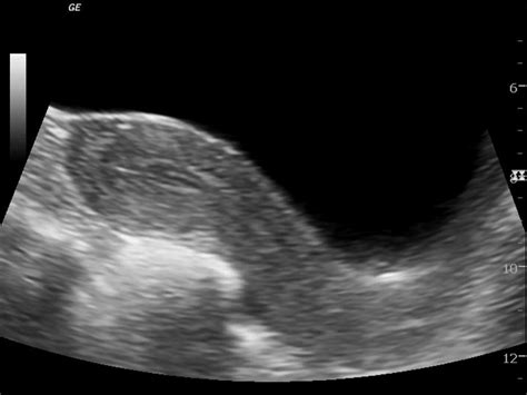 Ovarian Dermoid Cyst Ultrasound