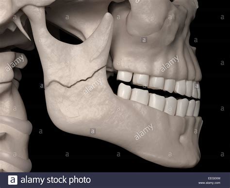 Ramus Bone Stock Photos & Ramus Bone Stock Images - Alamy
