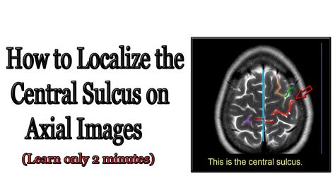 How to localize the central sulcus on axial images (short note 1 ) - YouTube