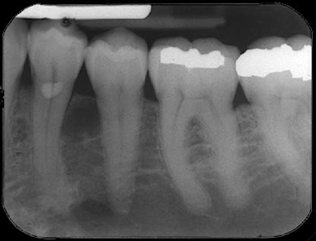 Lateral Periodontal Cyst – Dr. G's Toothpix