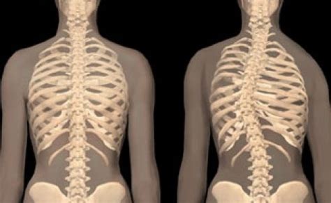 Scoliosis Definition : What Is Scoliosis ? | Health And Beauty