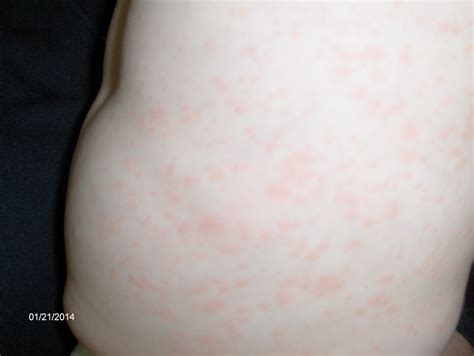 Roseola-Rash-Fever Urgent Care Pediatrics-Dr. Phillips-32819 - Urgent Care Walk-In Medical ...