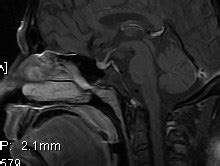 Tuber cinereum hamartoma-MRI - Sumer's Radiology Blog