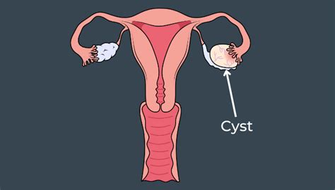 Fibroids Vs Cysts – How Are They Detected? - Dr Mustafa Aldam ...