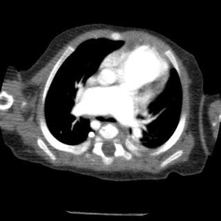 Echocardiographic imaging of atrioventricular septal defect, left ...