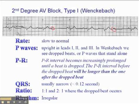 ECG: 2nd AV Block Type 1 - YouTube