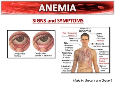 ANEMIA