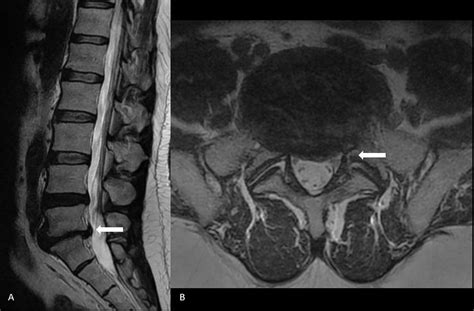 Herniated Disc Mri L5 S1 - Lumbar Herniated Disc - A More in Depth Look ...