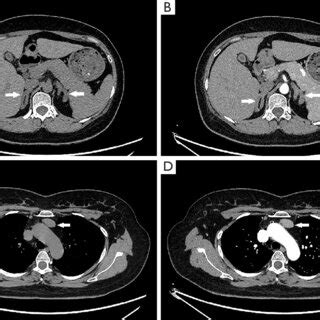 Adrenal and chest plain and enhanced CT scan preoperative. (A) Plain CT ...