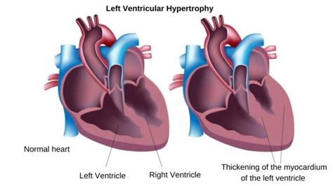 Left Ventricular Hypertrophy (LVH) – Symptoms, Causes and Treatment