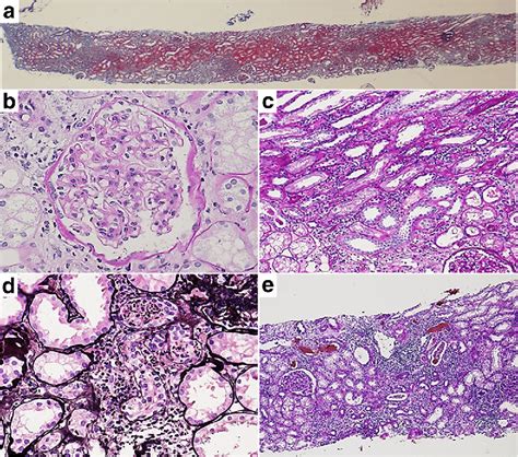 Kidney biopsy slide specimen showing: a subcapsular and medullary ray... | Download Scientific ...