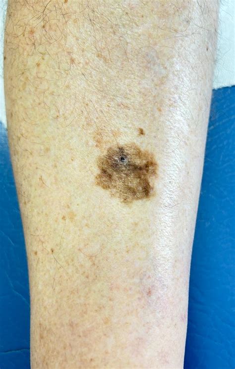 Skin Cancer on Legs - Everything You Need to Know