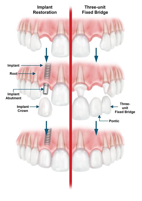 Here are some options to replace a lost #tooth or teeth. Bridges: Anchored to your adjacent ...